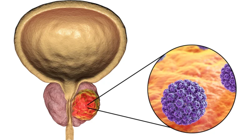 Cáncer de próstata: Presta atención a estas señales