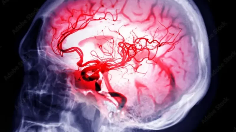 Los casos de derrame cerebral están aumentando, especialmente en personas jóvenes… y esta es la razón